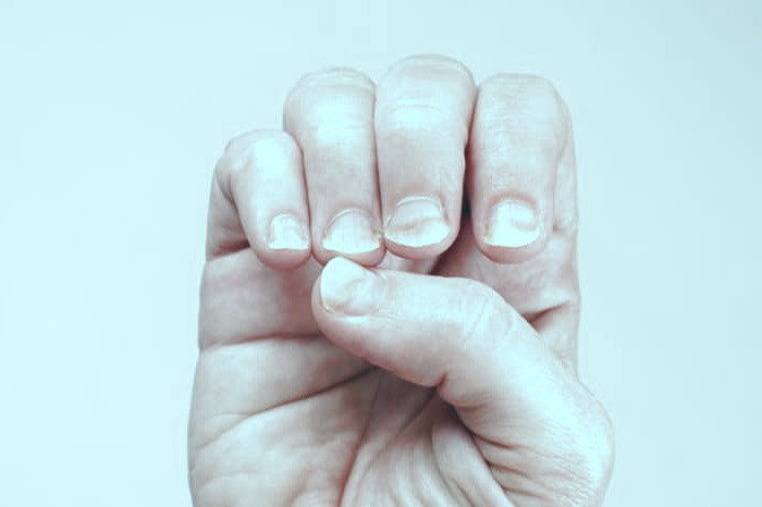 زرد شدن ناخن دست و زرد شدن ناخن پا  زرد شدن ناخن