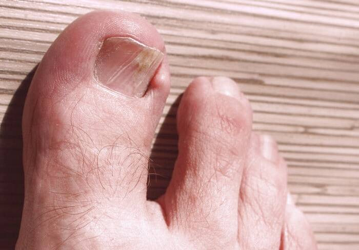 علائم سندروم ناخن زرد علائم زرد شدن ناخن