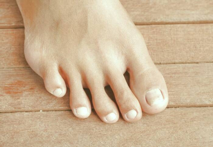 علت زرد شدن ناخن ها زرد شدن ناخن دست