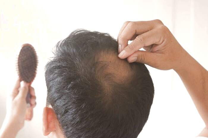 ریزش مو به دلیل کمبود چربی ریزش مو