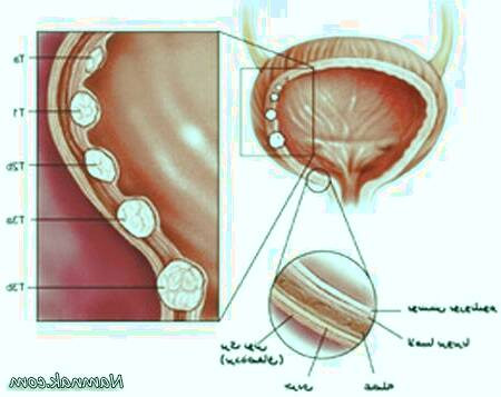 سنگ مثانه چگونه به وجود می آید  سنگ مثانه