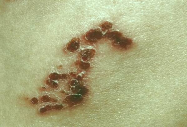 بیماری زونا