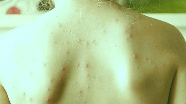 جای زخم زونا