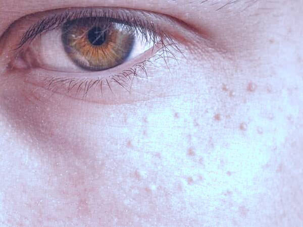 جوش های سفید زیر پوستی یا میلیا