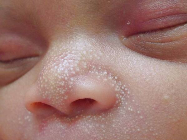 جوش های سفید زیر پوستی در نوزادان 