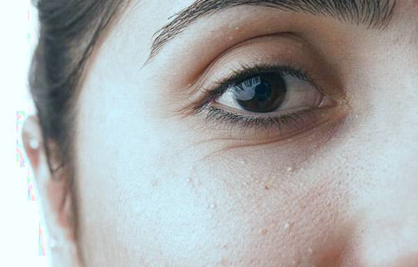 انواع جوش های سفید زیر پوستی 