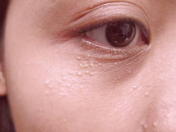 علل جوش های سفید زیر پوستی یا میلیا