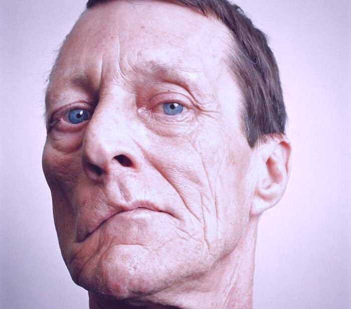 بیماری فلج بلز فلج صورت