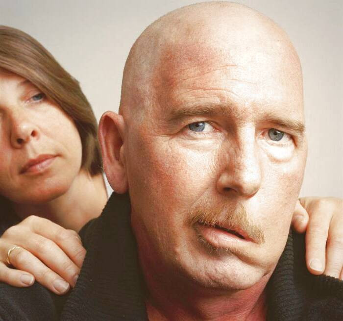 بیماری بلز پالسی فلج صورت درمان