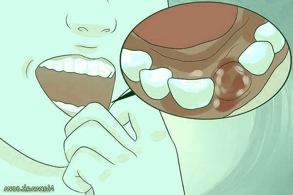 لخته شدن خون در دندان