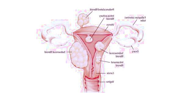 روش تشخیص فیبروئیدهای رحمی