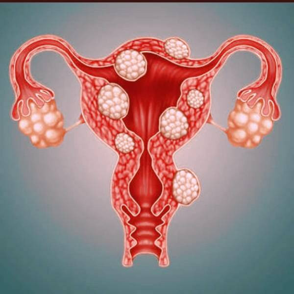 فیبروم رحمی 