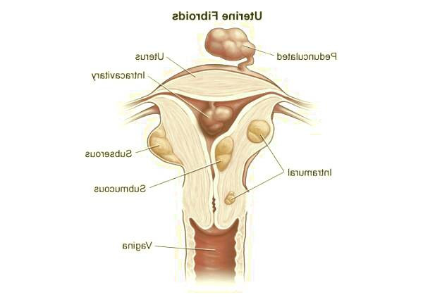 درمان های فیبروم رحم
