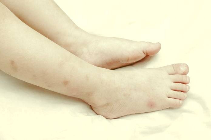 کمک اولیه کنه