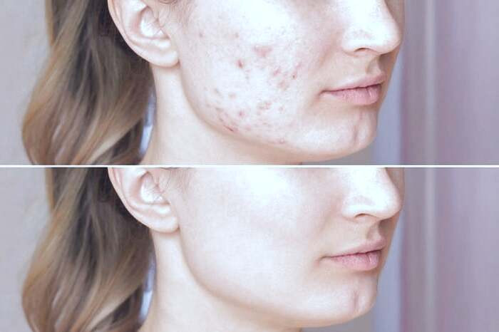 آکنه های شدید