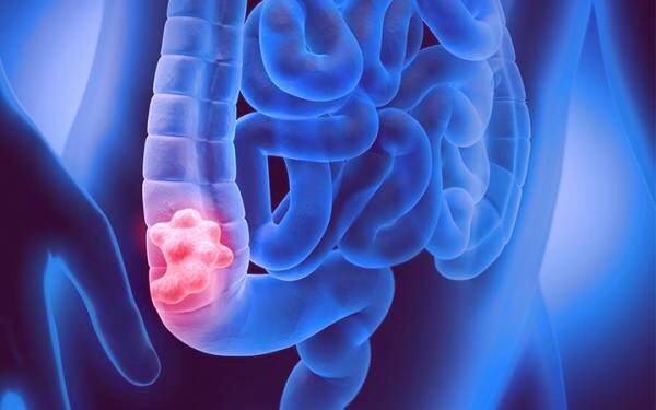 تشخیص سرطان روده