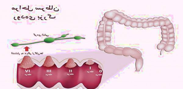 سرطان روده بزرگ