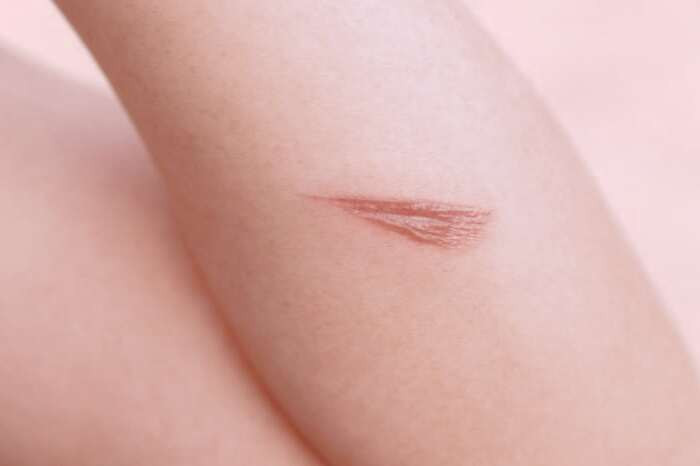 درمان سوختگی سطحی