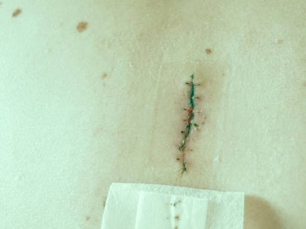 بخیه زدن زخم باز