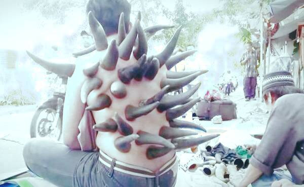 استون تراپی 