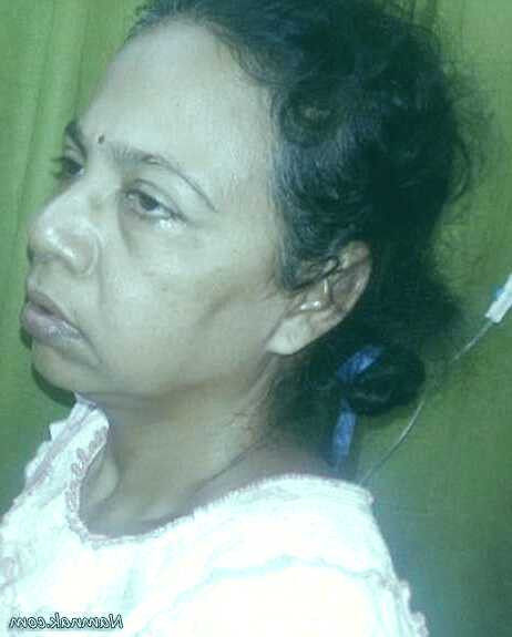 سنگ کیسه صفرا