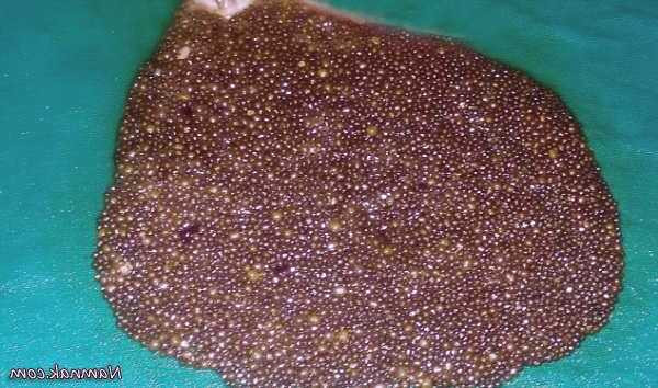 سنگ کیسه صفرا