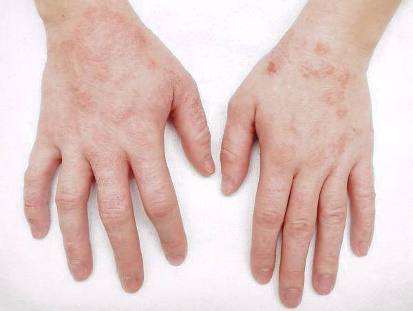 درماتیت تماسی