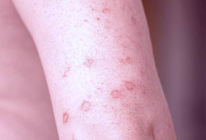 انواع کهیر پوستی