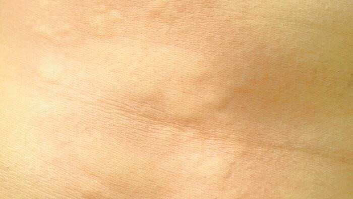 آنژیوادم چیست؟