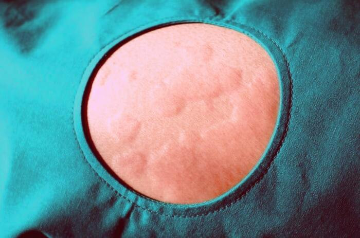 علت کهیر زدن