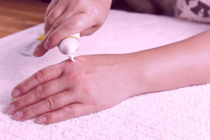 شرایط بروز کهیر