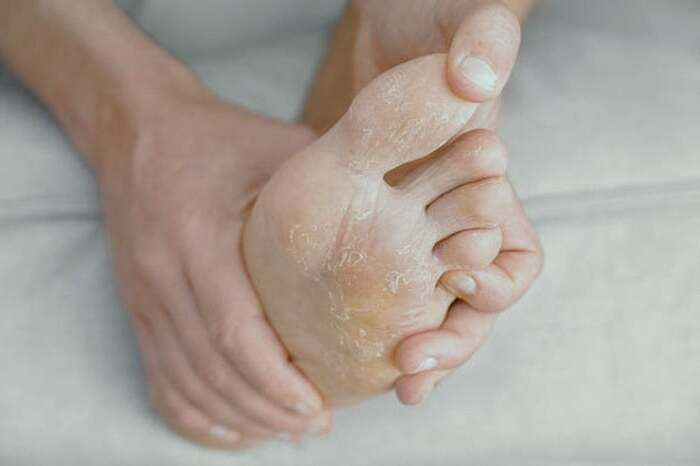 علائم کهیر زدن