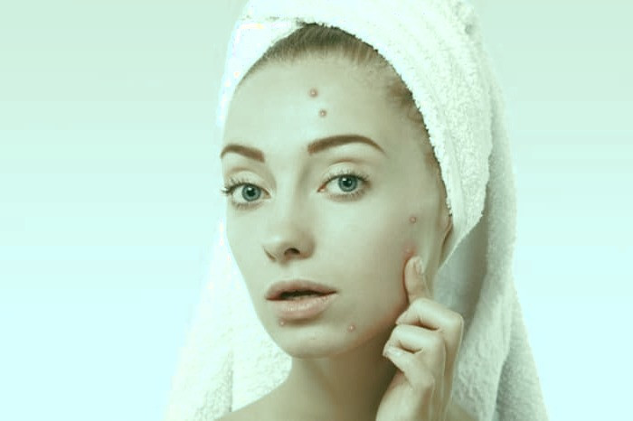 روش درمان آکنه 