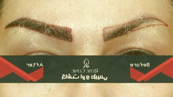 کاشت ابرو