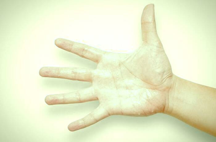 علل عرق کردن کف دست