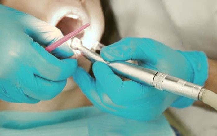 عصب کشی دندان 