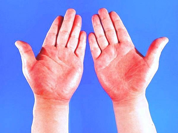 کف دست قرمز