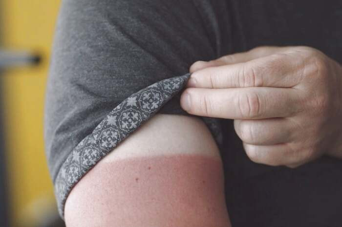 درمان آفتاب سوختگی با سیب زمینی