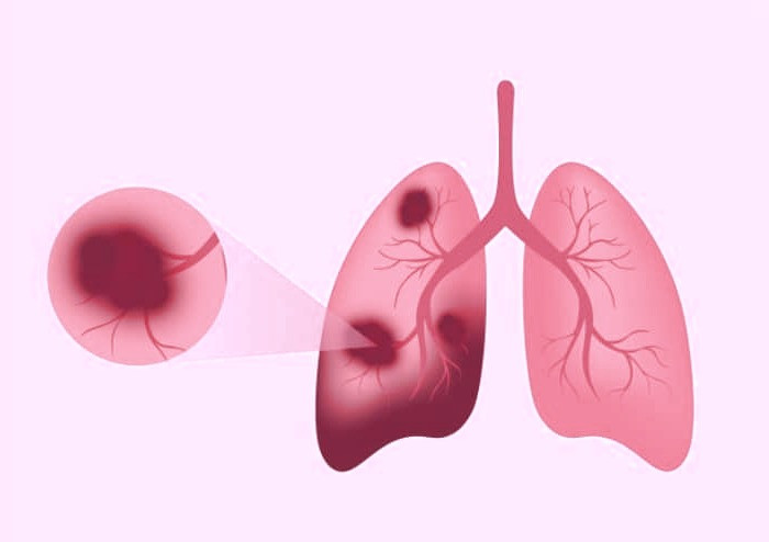 علت عفونت ریه