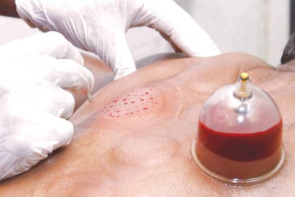 فصد خون یا حجامت 