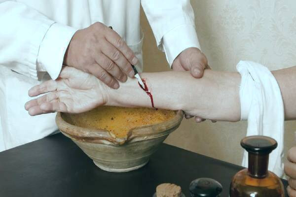 فصد خون چیست