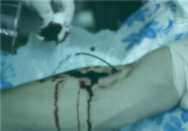 فصد خون چیست؟