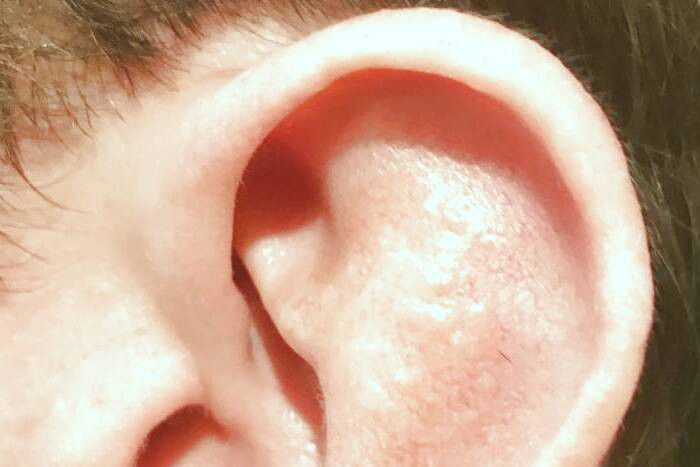 سندروم رمسی هانت