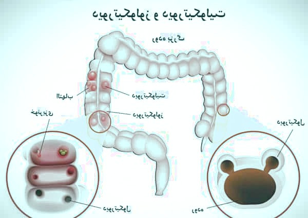 دیورتیکولیت