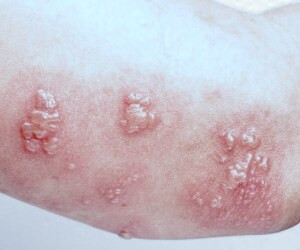 درمان بیماری کودکان کاوازاکی و راهکارهای پیشگیری