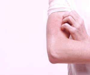 بررسی علل و درمان های طبیعی کهیر پوستی