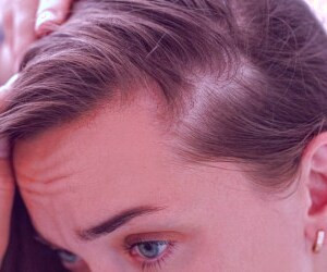 درمان ریزش مو ناشی از تیروئید با روش‌های طب سنتی