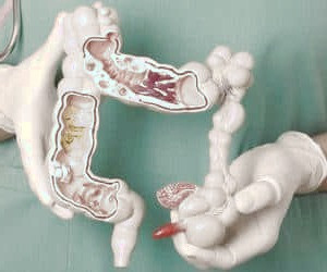 دیورتیکولیت و دیورتیکولوز: بررسی علل، علائم، تشخیص و روش‌های درمان