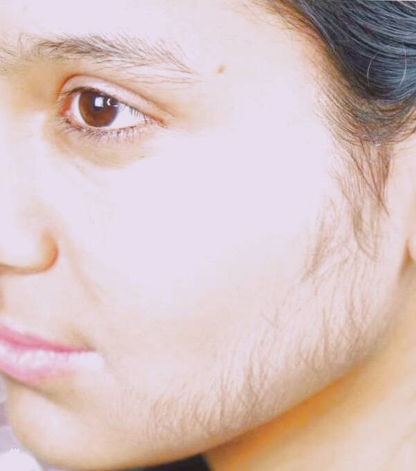 موهای زائد صورت