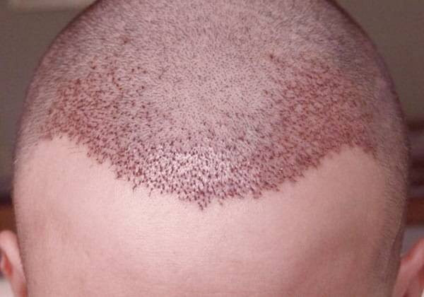 بعد کاشت مو